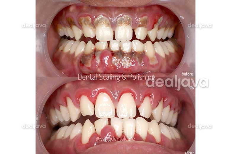 Perawatan Gigi Scaling Bleaching Veneer Orthodonti Pemasangan Behel Dari Yang Dental Care