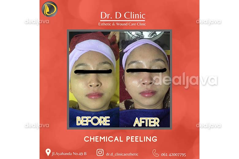 Treatment Super Glowing Facial Detox Pdt Chemical Peeling Ipl Laser Premium Blaxk Doll At Dr D Clinic Esthetic Wound Care